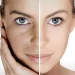 Facial Rejuvenation