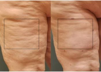 Exploring the Top Cellulite Treatments in Sydney for a Silkier, Smoother Skin