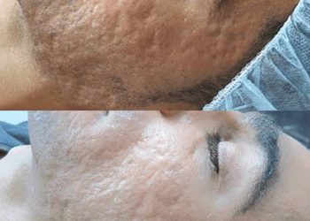 Revitalising Skin Health: Unveiling the Remarkable Benefits of Skin Needling