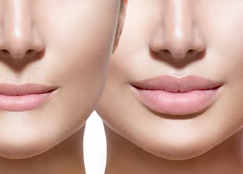 Lip Fillers