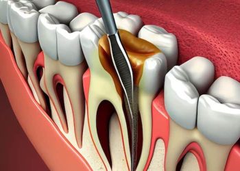 Root Canal