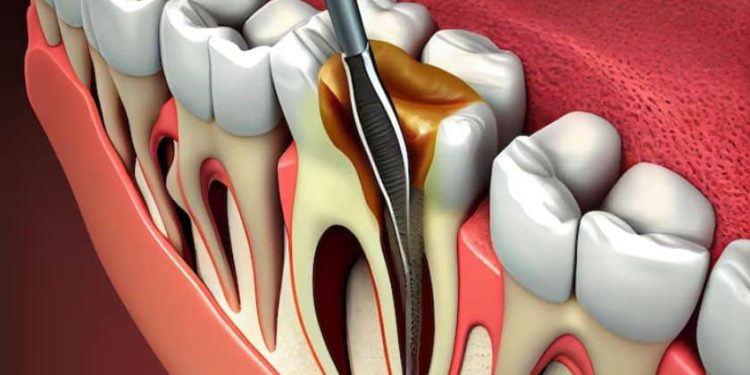 Root Canal