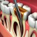 Root Canal