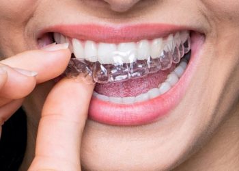 Transparent Teeth Braces