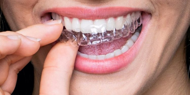Transparent Teeth Braces