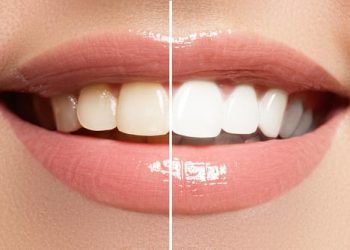 Whiten Your Teeth Again