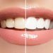 Whiten Your Teeth Again