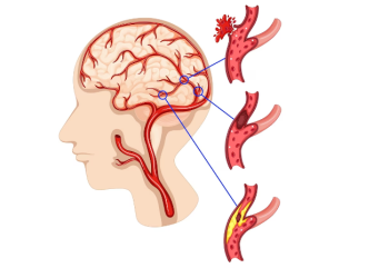 Cure for Brain Stroke? Check the Best Stroke Treatment in Bangalore