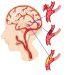 Cure for Brain Stroke? Check the Best Stroke Treatment in Bangalore