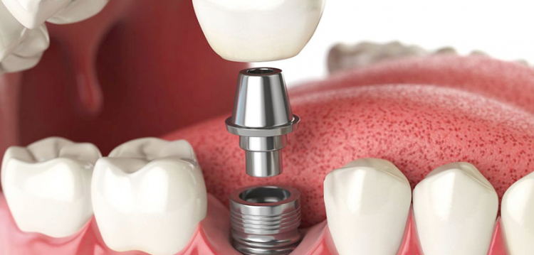 Dental Implants