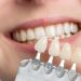 Braces to Veneers