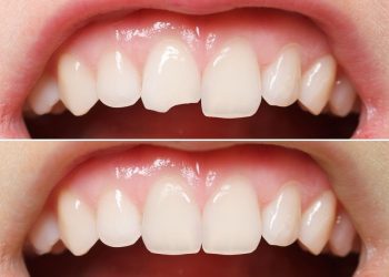 Cost of Tooth Bonding