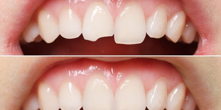 Cost of Tooth Bonding