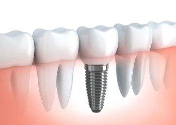 Dental Implant Restorations for Replacing Missing Teeth