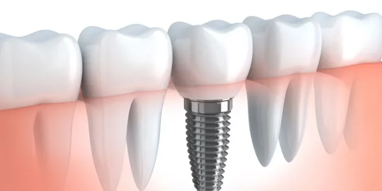 Dental Implant Restorations for Replacing Missing Teeth