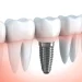 Dental Implant Restorations for Replacing Missing Teeth