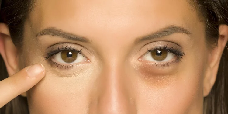 Get Rid Of Bags Under The Eyes