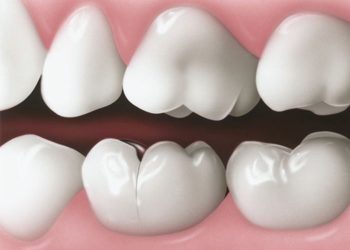 Hairline Fracture Tooth