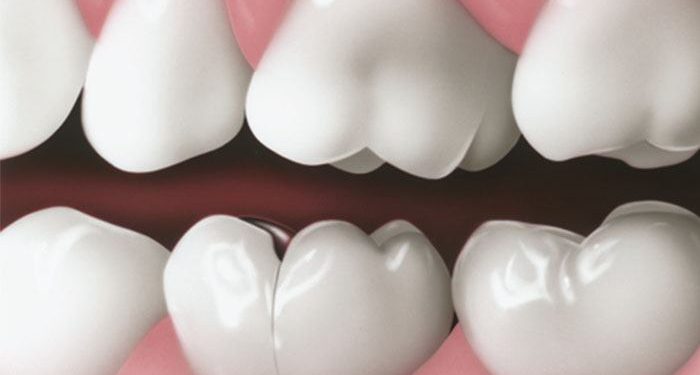 Hairline Fracture Tooth