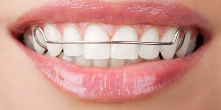 Orthodontic Appliances