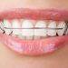 Orthodontic Appliances