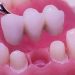 Teeth Replacement