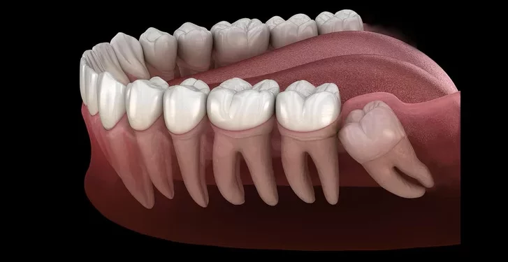 Wisdom teeth