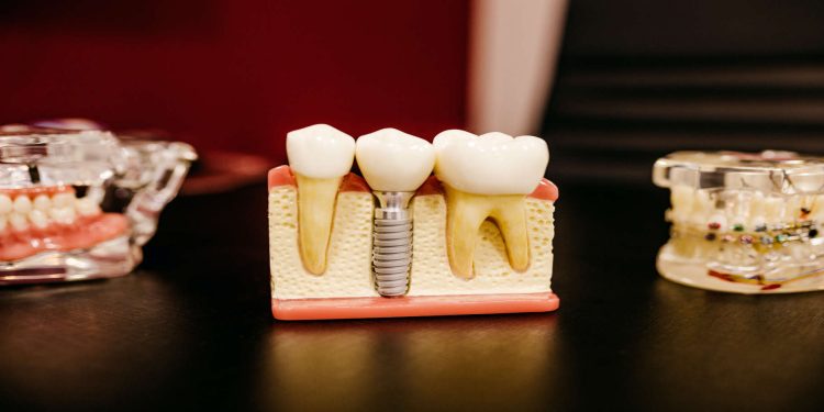 Tooth Implant