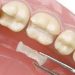 Dental Sealants Procedure