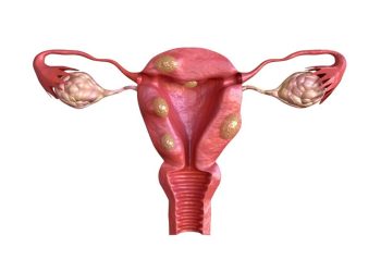 Fibroid Treatment