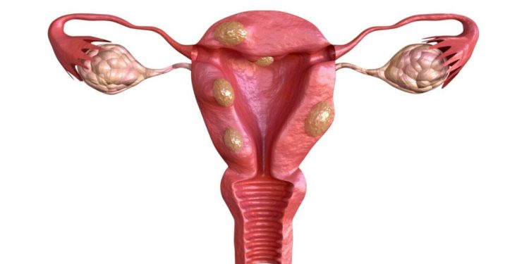 Fibroid Treatment