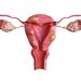 Fibroid Treatment