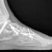 Hindfoot Fusion