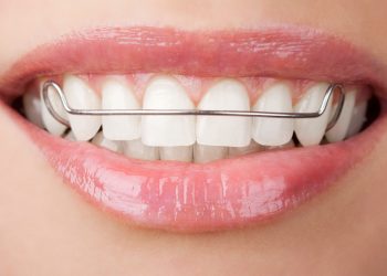 How Often Should I Wear My Retainer