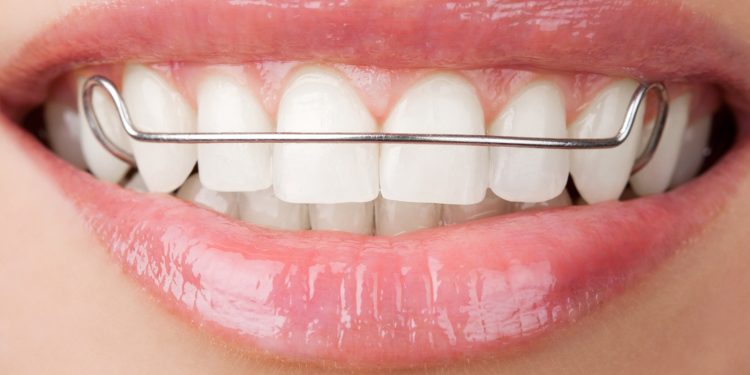 How Often Should I Wear My Retainer