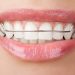 How Often Should I Wear My Retainer