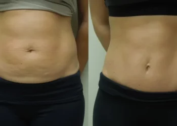 Mini Tummy Tuck