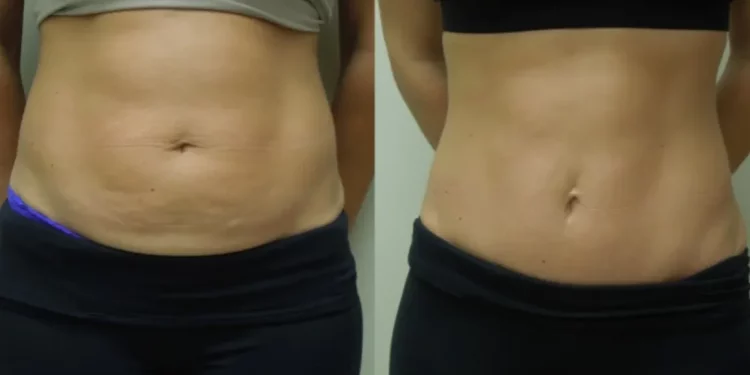 Mini Tummy Tuck