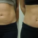 Mini Tummy Tuck
