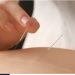 What are the benefits of acupuncture?