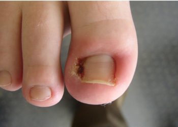 Ingrown Toenail: Causes, Symptoms, and Treatment