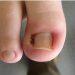 Ingrown Toenail: Causes, Symptoms, and Treatment