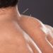 Can Acupuncture Really Ease Anxiety? Here’s What You Should Know