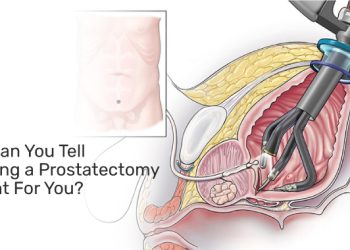 How Can You Tell If Having A Prostatectomy Is Right For You?
