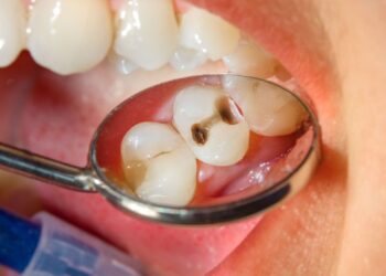 How Long Does a Filling Take