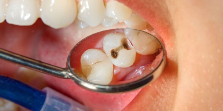 How Long Does a Filling Take