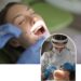 Dental Fillings