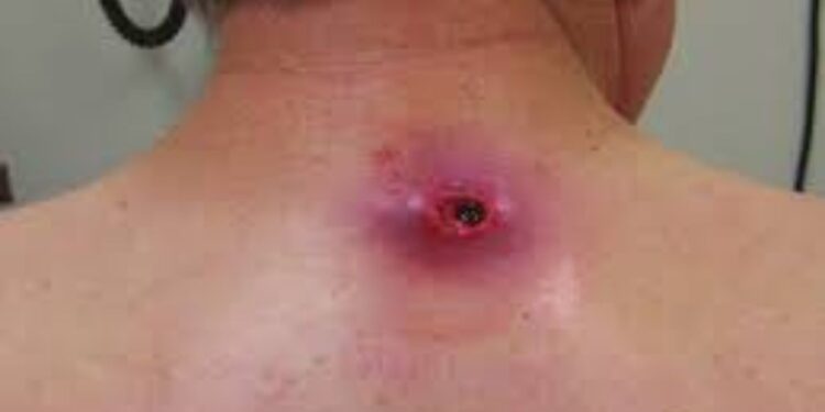 Sebaceous Cyst Wound Healing Time