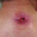 Sebaceous Cyst Wound Healing Time