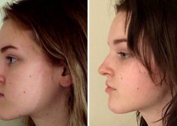 Jaw Aesthetic Surgery